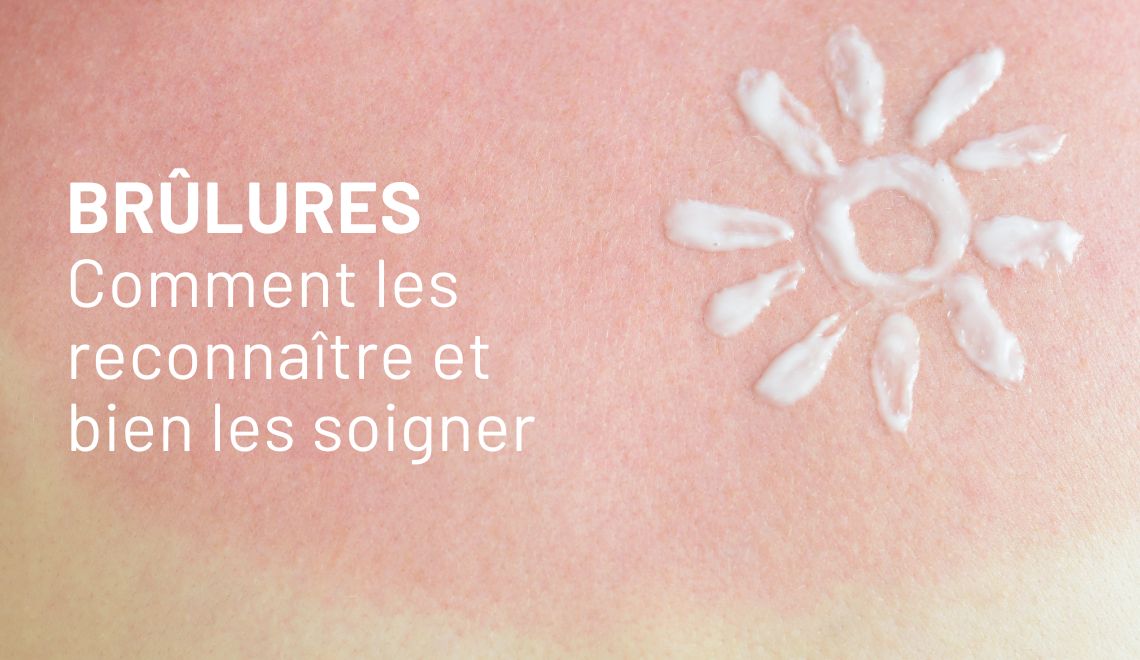 Brûlures : comment les reconnaître et bien les soigner