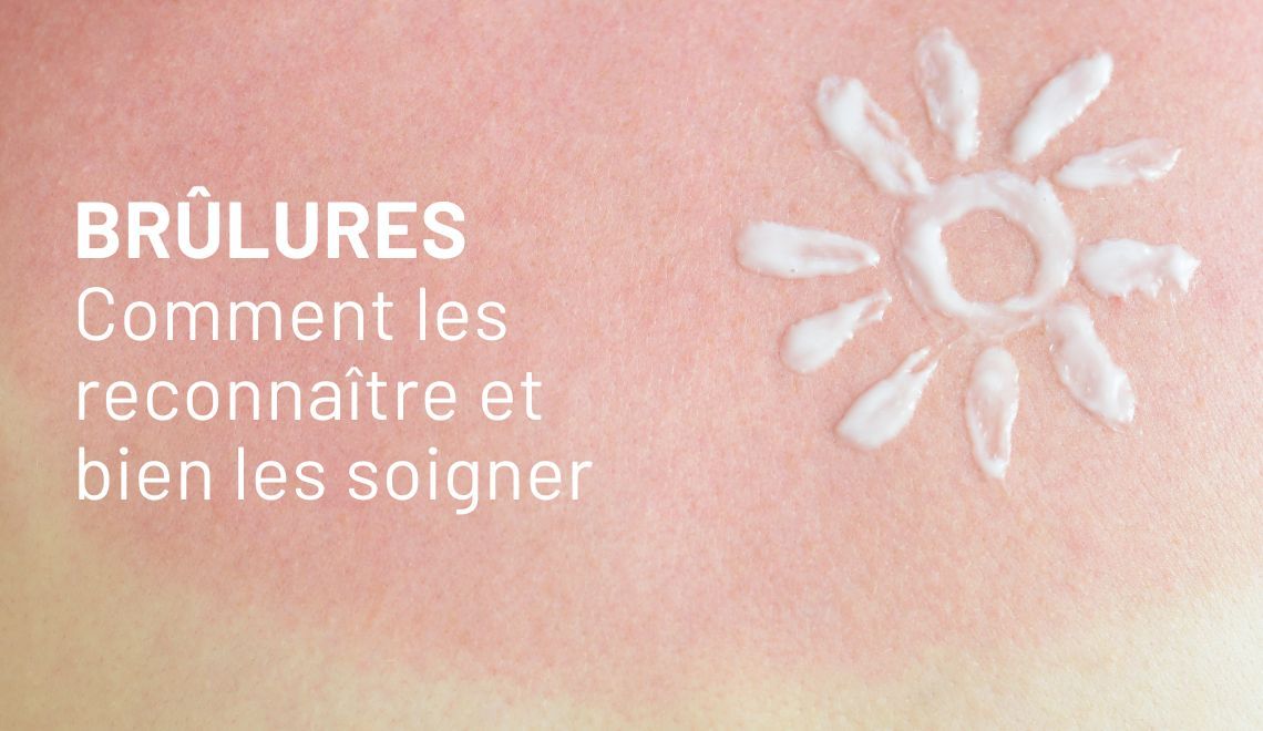 Brûlures : comment les reconnaître et bien les soigner