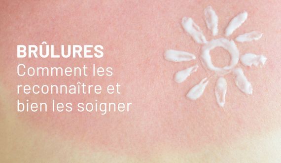Brûlures : comment les reconnaître et bien les soigner